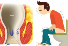 Особенности геморроя