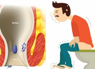Особенности геморроя