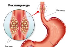 Лечение рака пищевода