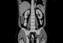 Компьютерная томография органов брюшной полости