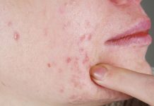 Как вылечить прыщи?
