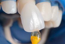 Все, что нужно знать о винирах — руководство для пациентов