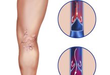 Как образуется варикоз и как его предотвратить?