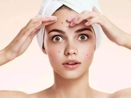 Как бороться с акне: советы