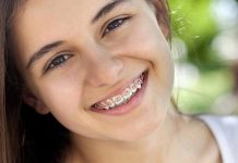 Все о выравнивании зубов с помощью брекетов