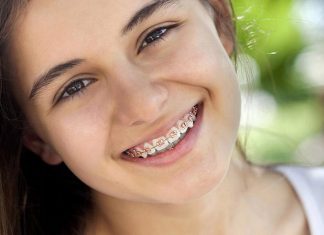 Все о выравнивании зубов с помощью брекетов
