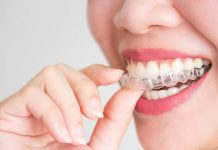 В каких случаях назначают каппы для исправления прикуса