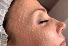 Почему широко популярна салонная процедура биоревитализация: советы