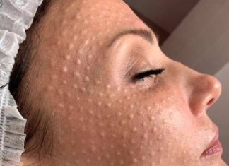 Почему широко популярна салонная процедура биоревитализация: советы