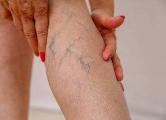Признаки варикоза ног у женщин: симптомы