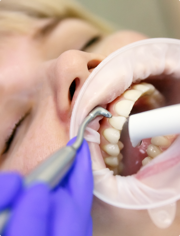 Как стоматологи делают чистку зубов. Профгигиена (ультразвук + Air-Flow). Профгигиена полости рта Air Flow. Профгигиена зубов ультразвуком.