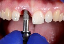 Плюсы одномоментной имплантации зубов: плюсы, противопоказания