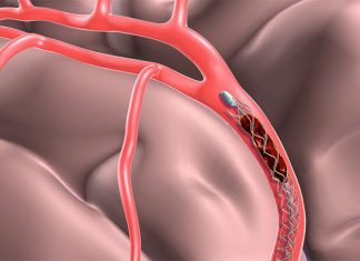 Что за операция тромбэктомия: когда она показана при внешнем геморрое