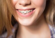Прямые зубы: мифы и реальность о брекетах