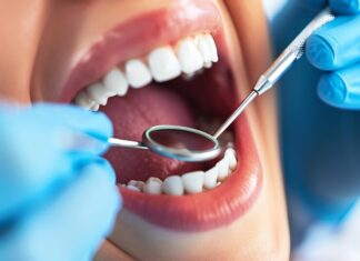 Ретейнеры для выравнивания зубов: что нужно знать?