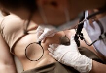 Удаление папиллом: методы, показания и рекомендации