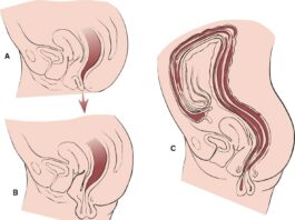 Пролапс матки — не приговор, а повод действовать!