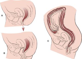 Пролапс матки — не приговор, а повод действовать!