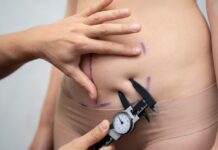 Липоскульптурирование: создание идеальной фигуры