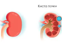 Лечение кисты почки: эффективные методы и современные технологии