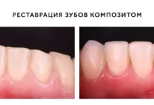 Что такое композитные виниры и когда стоит их устанавливать