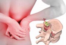 Основные причины развития: почему возникают грыжа дисков и спондилоартроз