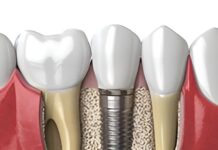Наращивание костной массы: основные принципы и методы