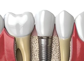 Наращивание костной массы: основные принципы и методы