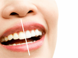 Отбеливание зубов: улыбайтесь чаще!