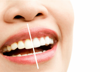 Отбеливание зубов: улыбайтесь чаще!