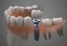 Имплантация зубов в Москве: современные методы и технологии