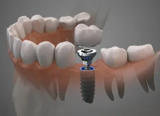 Имплантация зубов в Москве: современные методы и технологии