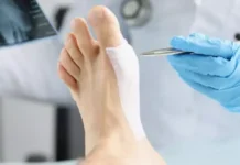 Иссечение подошвенного апоневроза