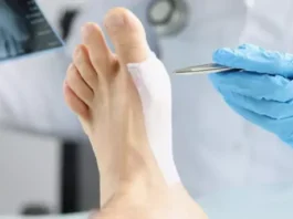 Иссечение подошвенного апоневроза