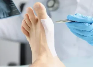 Иссечение подошвенного апоневроза